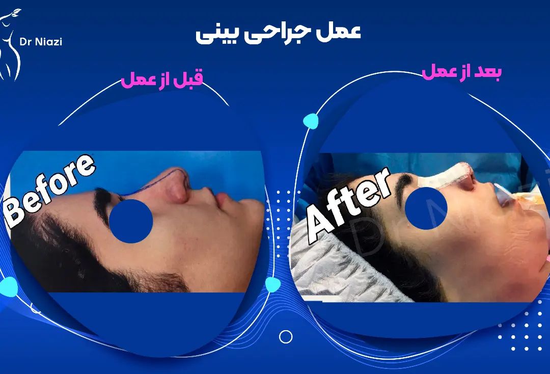 جراحی زیبایی بینی زیباجوی در کلینیک زیبایی و فوق تخصصی دکتر فیض الله نیازی